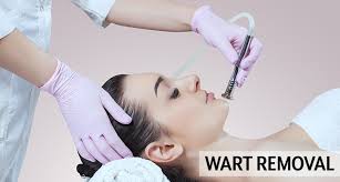 wart-removal-treatment