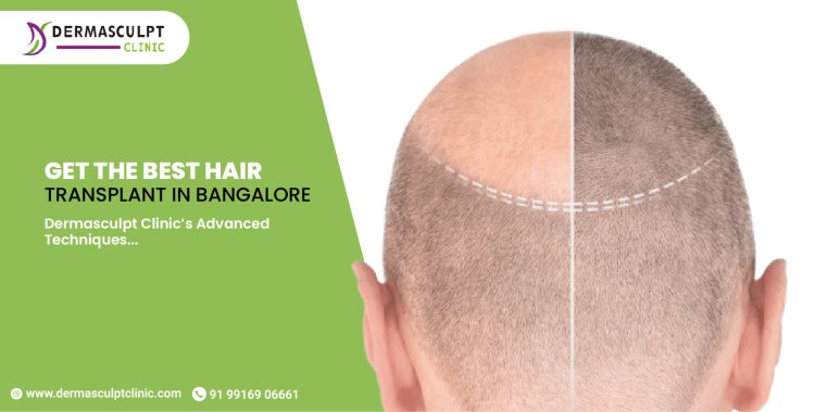 Get the Best Hair Transplant in Bangalore: Dermasculpt Clinic’s Advanced Techniques