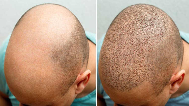 Discover the Best Hair Transplant Clinic in Jayanagar: Dermasculpt's Unmatched Expertise