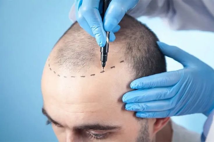 Unmatched Hair Transplant Results in Jayanagar: Why Dermasculpt Clinic Is the Go-To Choice in Bangalore