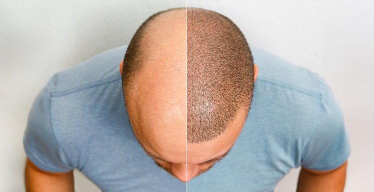 Top Hair Transplant Clinic in Bangalore: Why Dermasculpt Clinic in Jayanagar Is Your Best Choice