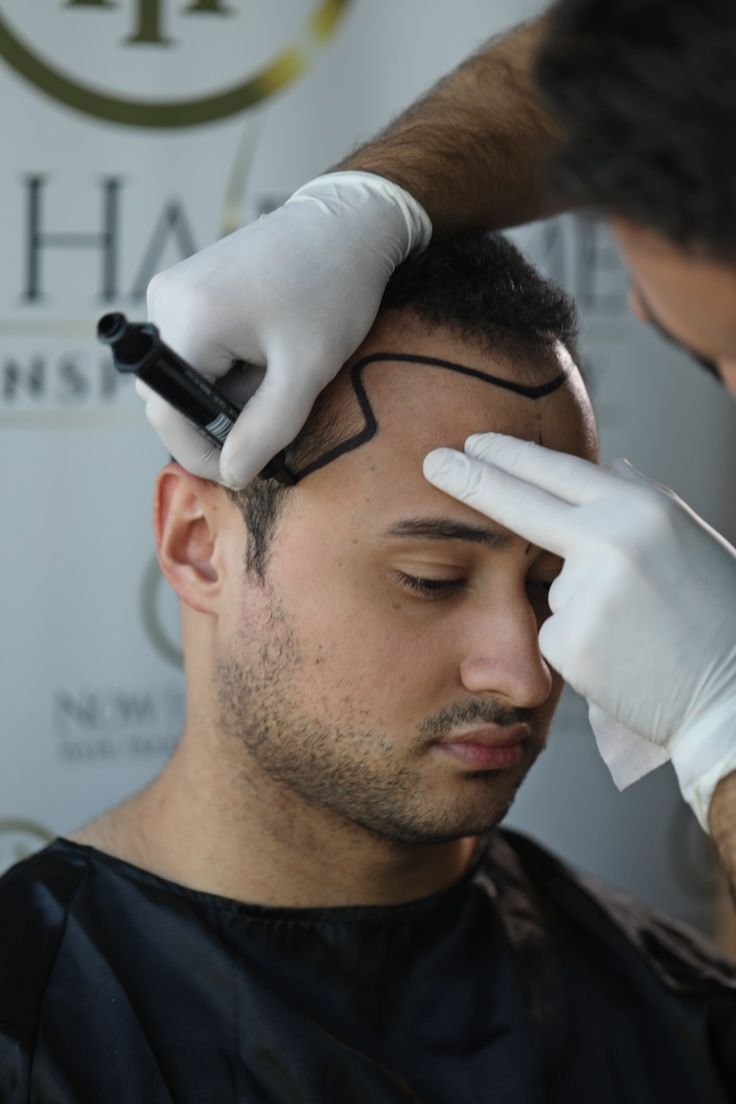 Expert Hair Transplants in Jayanagar, Bangalore: Dermasculpt Clinic for Natural Results