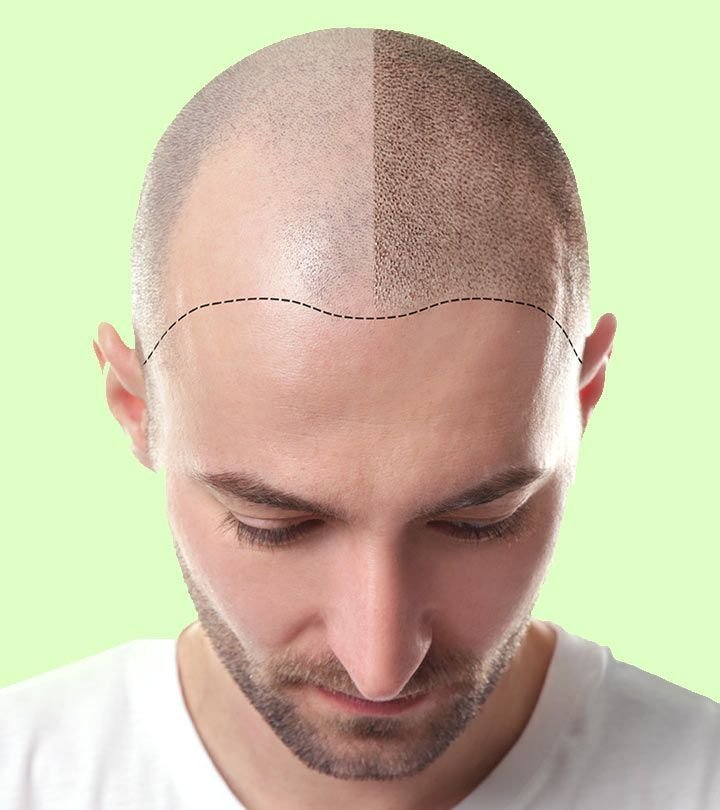 Dermasculpt Clinic: Leading Hair Transplant Experts in Jayanagar, Bangalore for Natural, Lasting Results