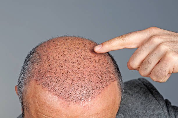 Transform Your Look with Dermasculpt Clinic: The Leading Hair Transplant & Dermatology Experts in Jayanagar, Bangalore – Where Confidence Meets Perfection