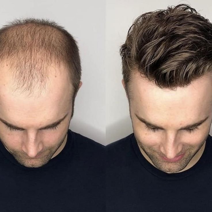 Get Natural-Looking Hair with the Best Hair Transplant at Dermasculpt Clinic